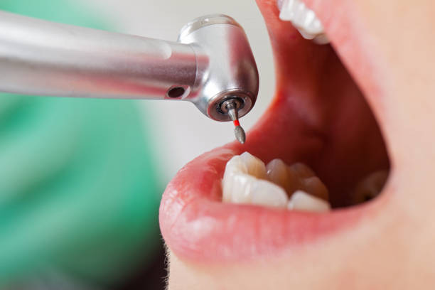 Best Emergency Treatment for Dental Infections or Abscesses in Morgandale, OH